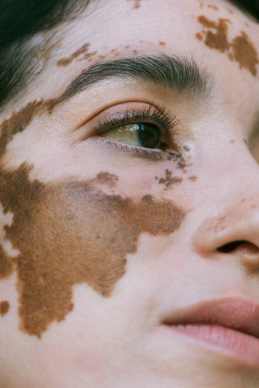Models with vitiligo: beautiful and amazing