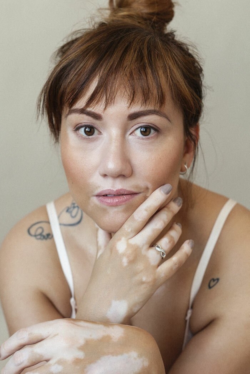 Models with vitiligo: beautiful and amazing