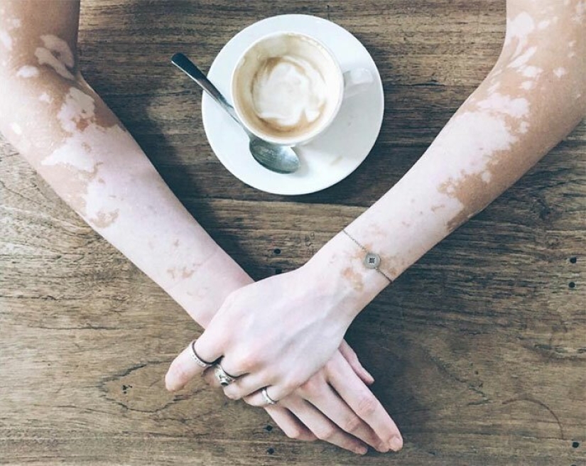 Models with vitiligo: beautiful and amazing