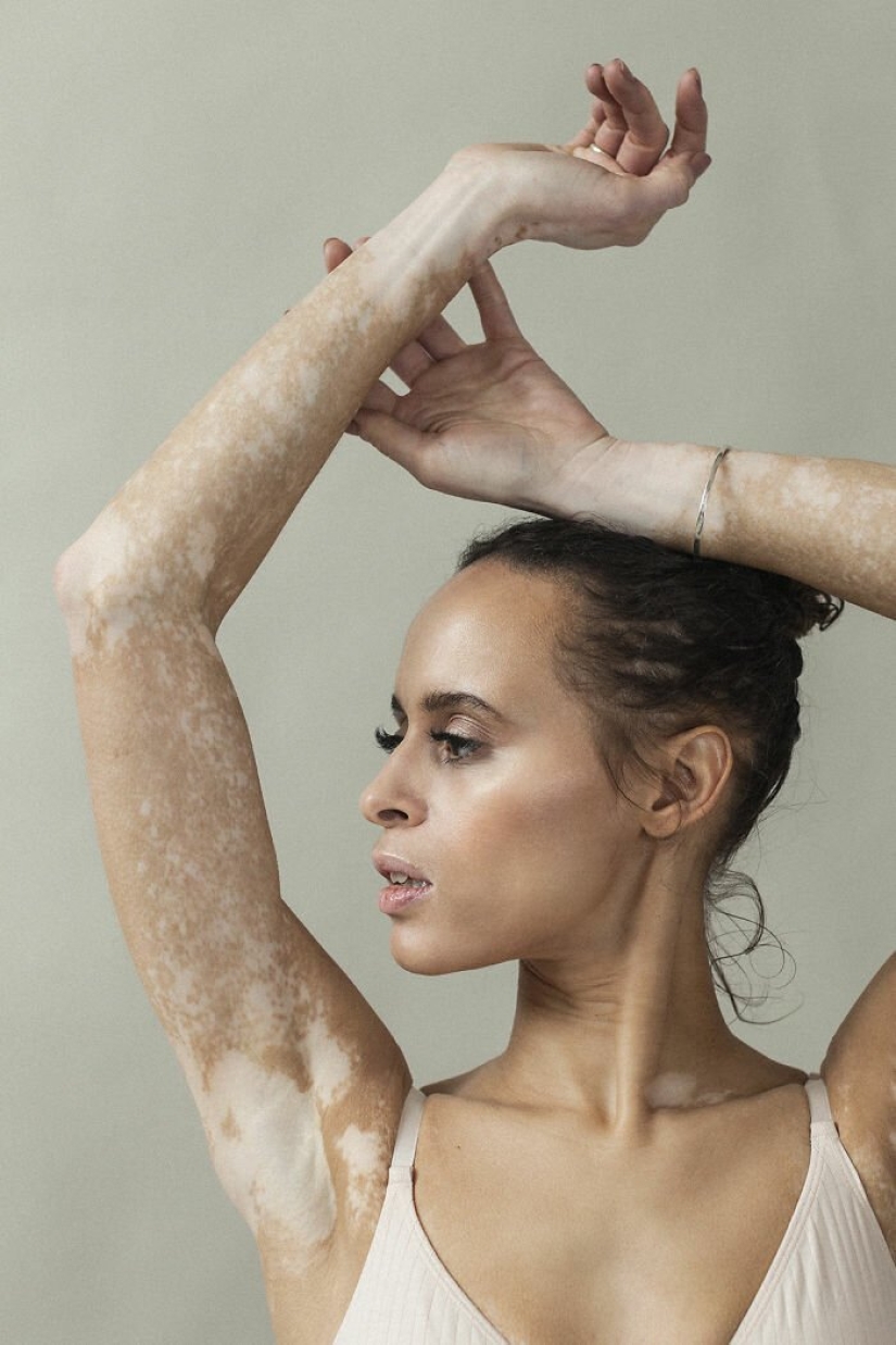 Models with vitiligo: beautiful and amazing