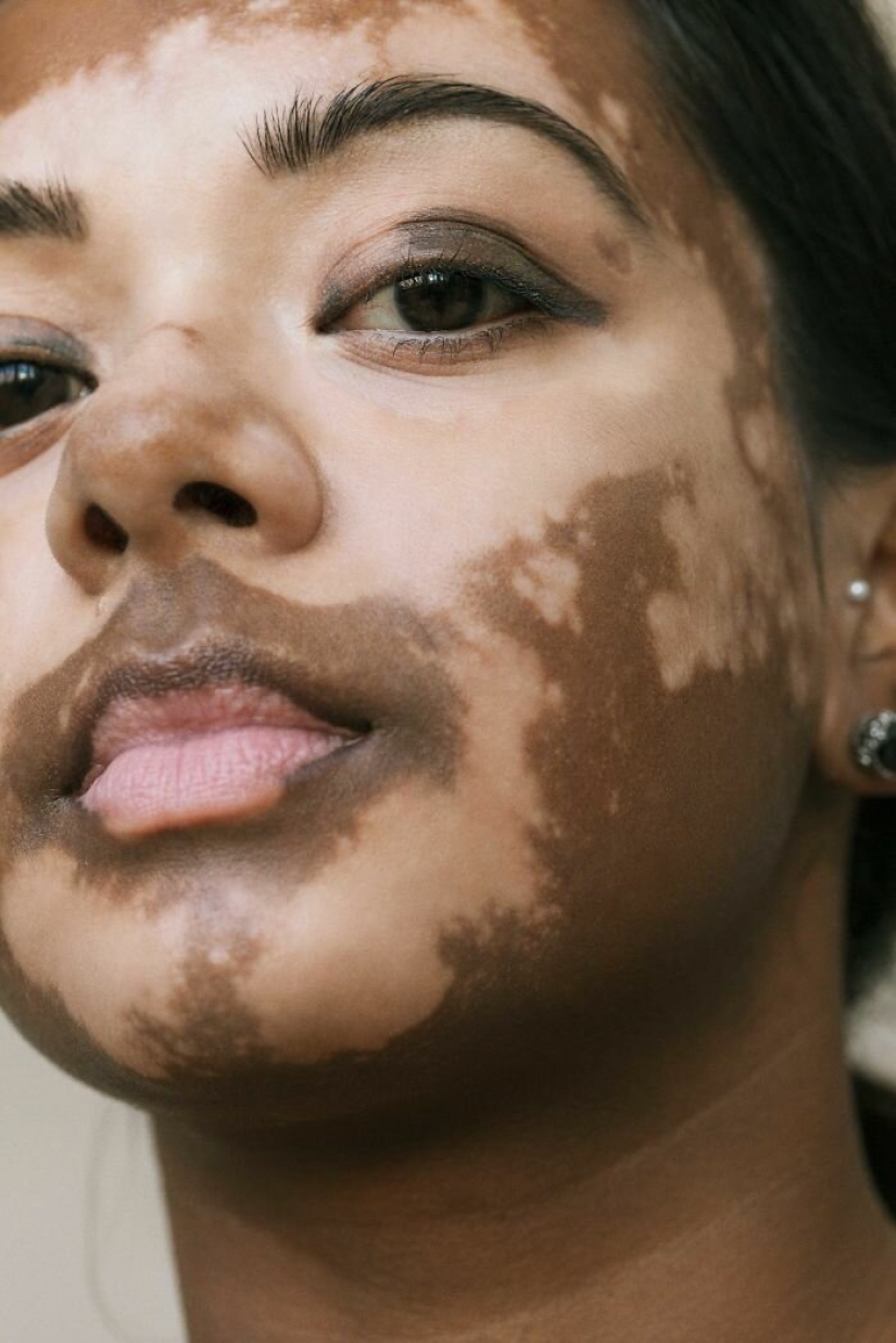 Models with vitiligo: beautiful and amazing