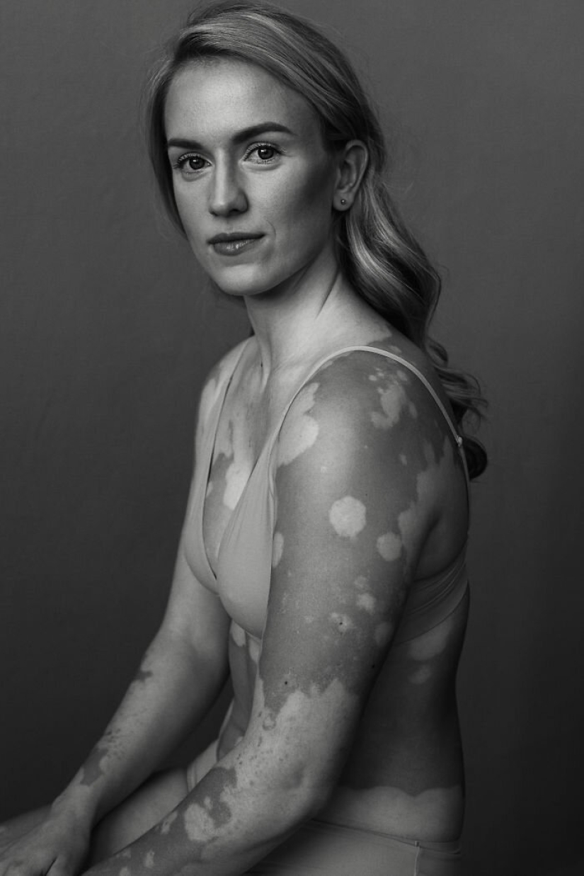 Models with vitiligo: beautiful and amazing