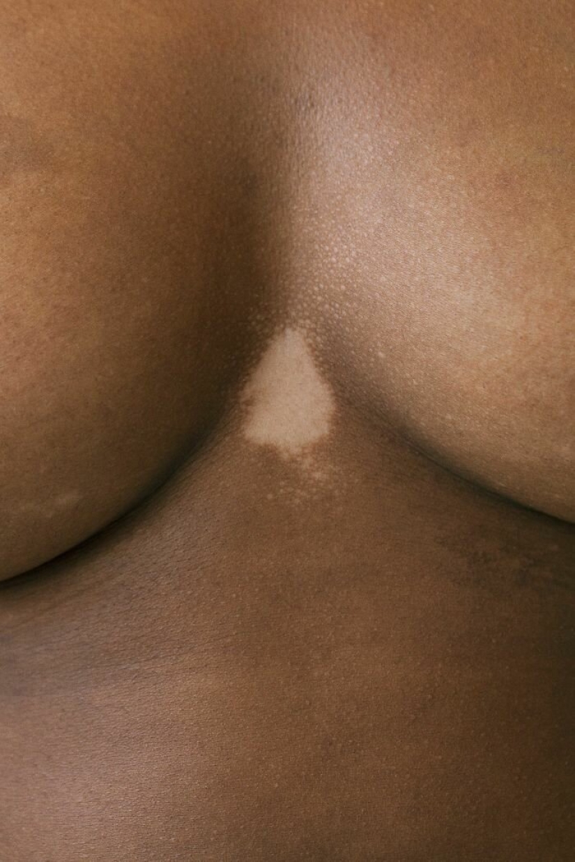 Models with vitiligo: beautiful and amazing