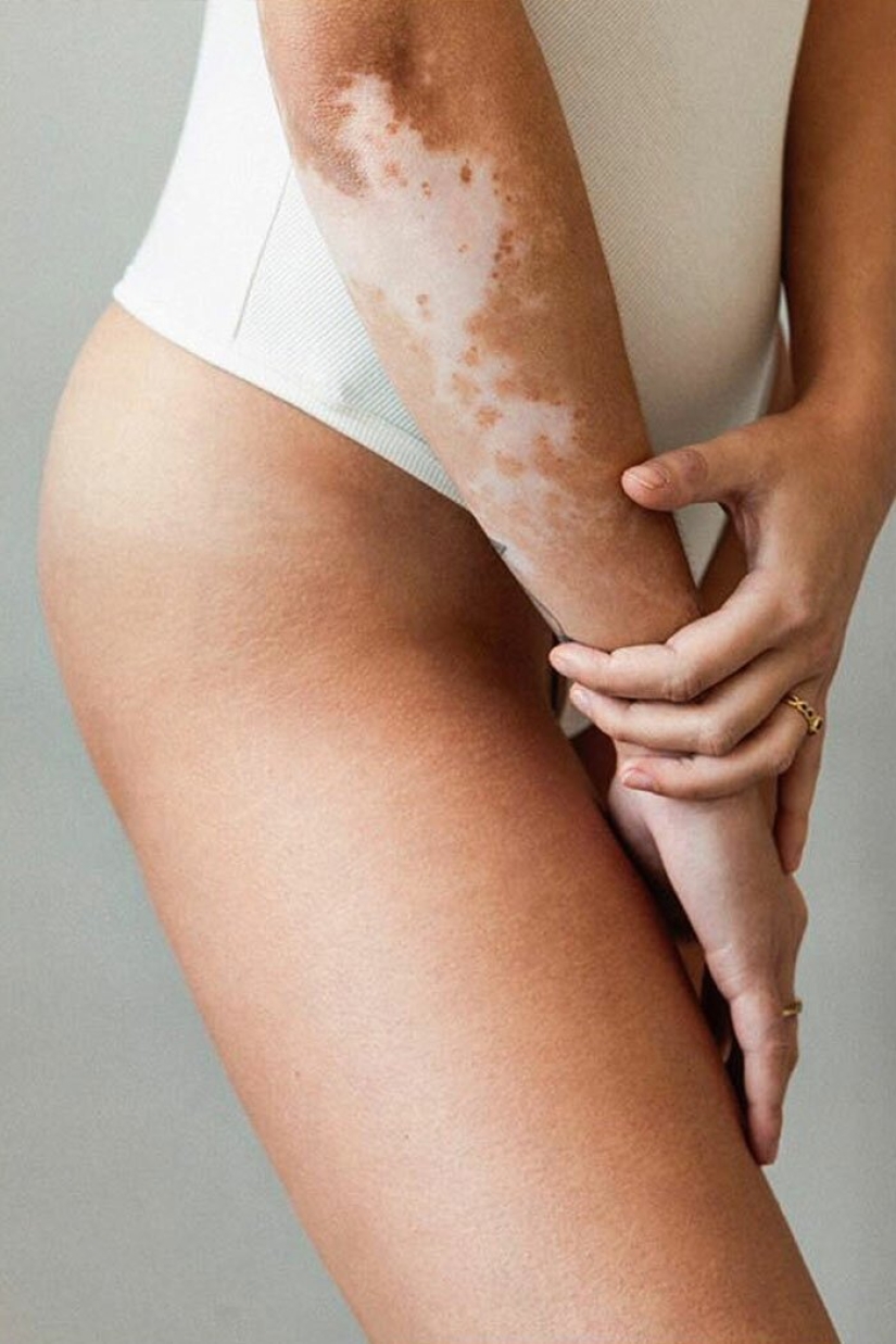 Models with vitiligo: beautiful and amazing