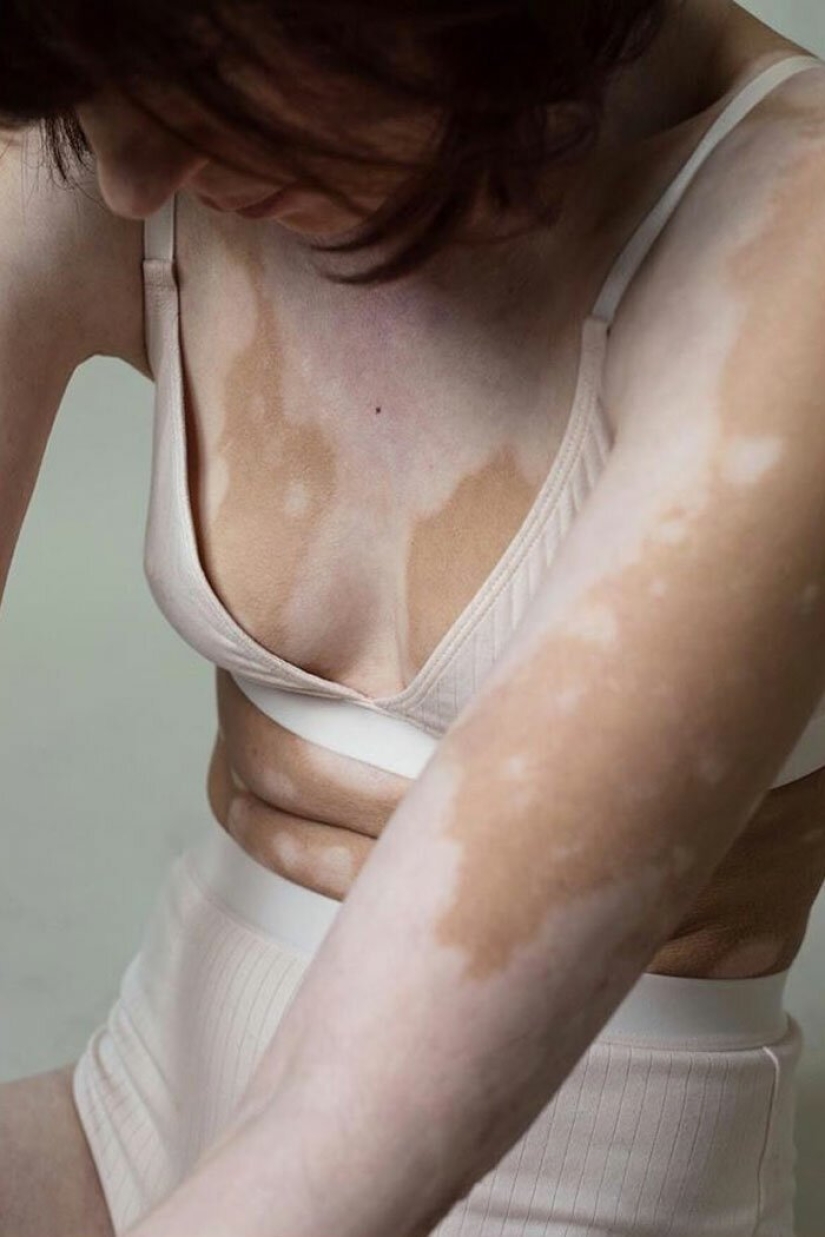 Models with vitiligo: beautiful and amazing