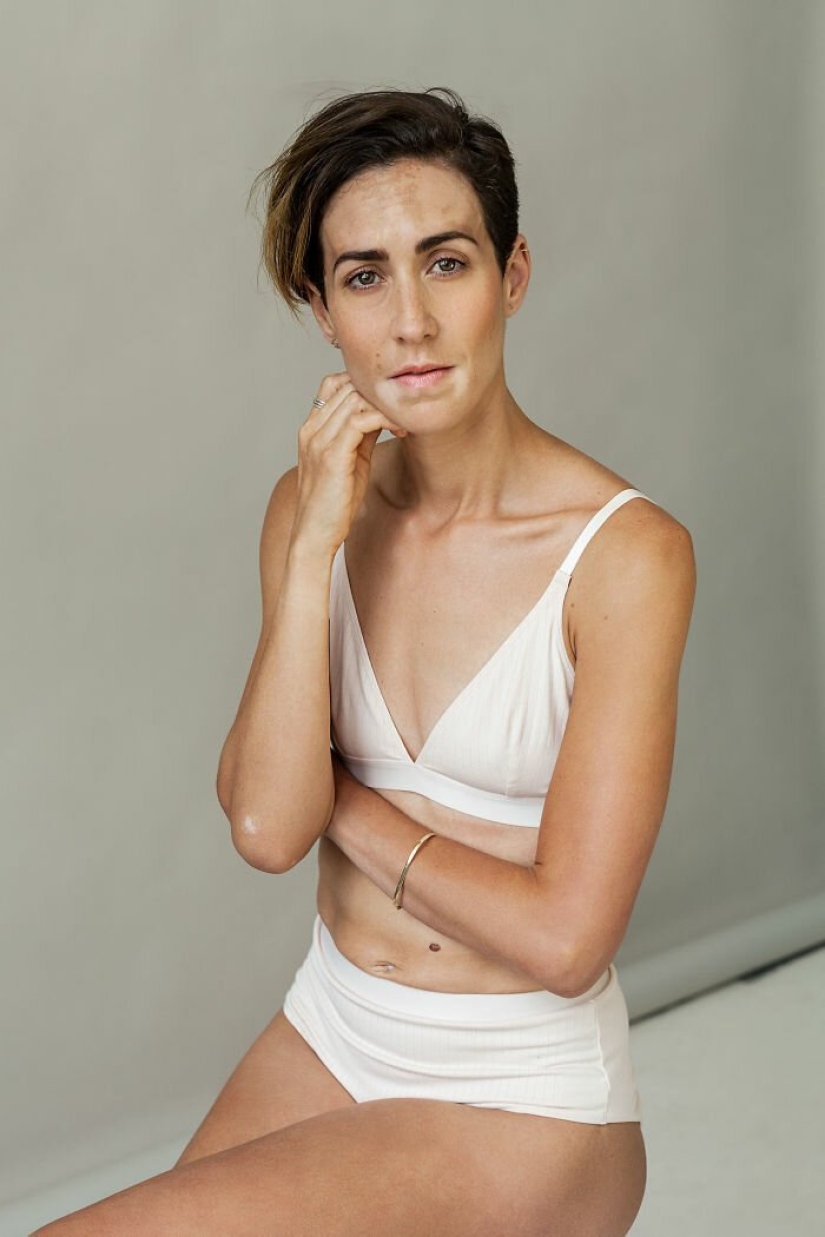 Models with vitiligo: beautiful and amazing