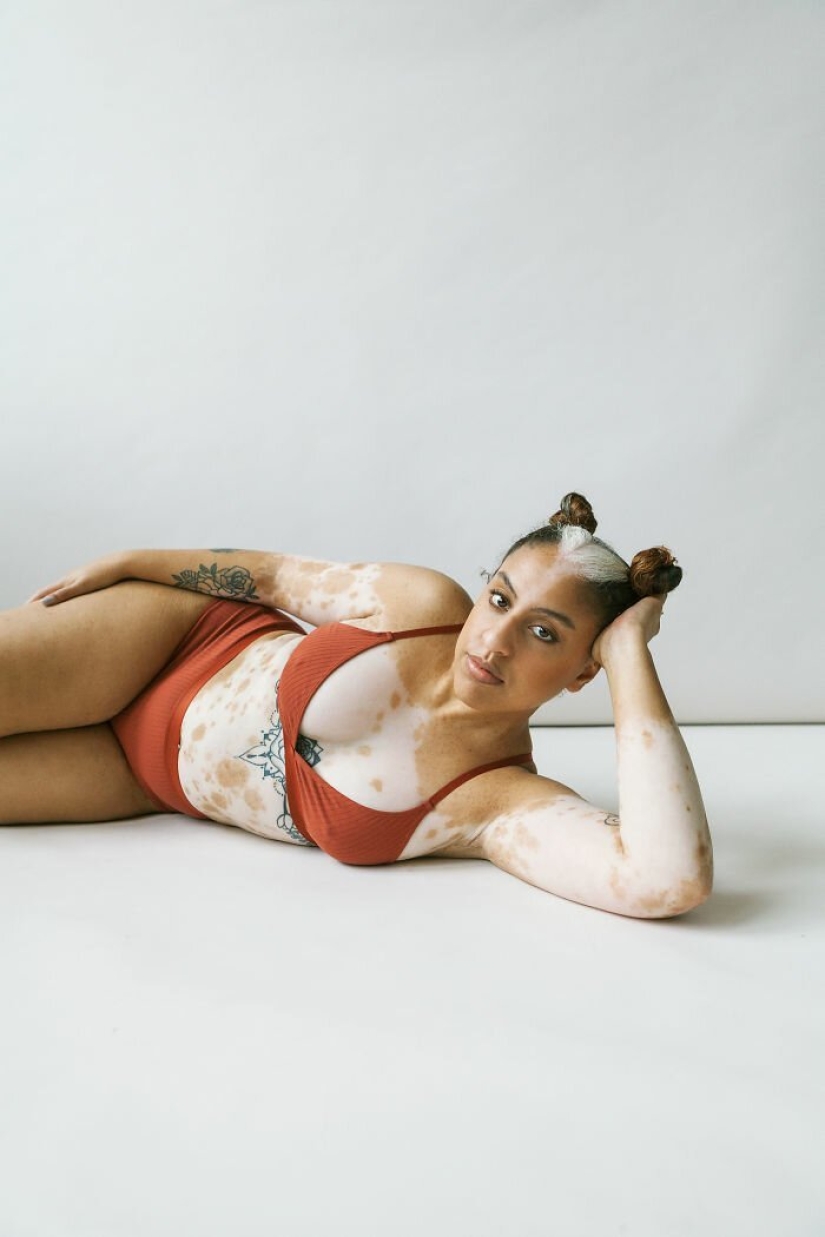 Models with vitiligo: beautiful and amazing