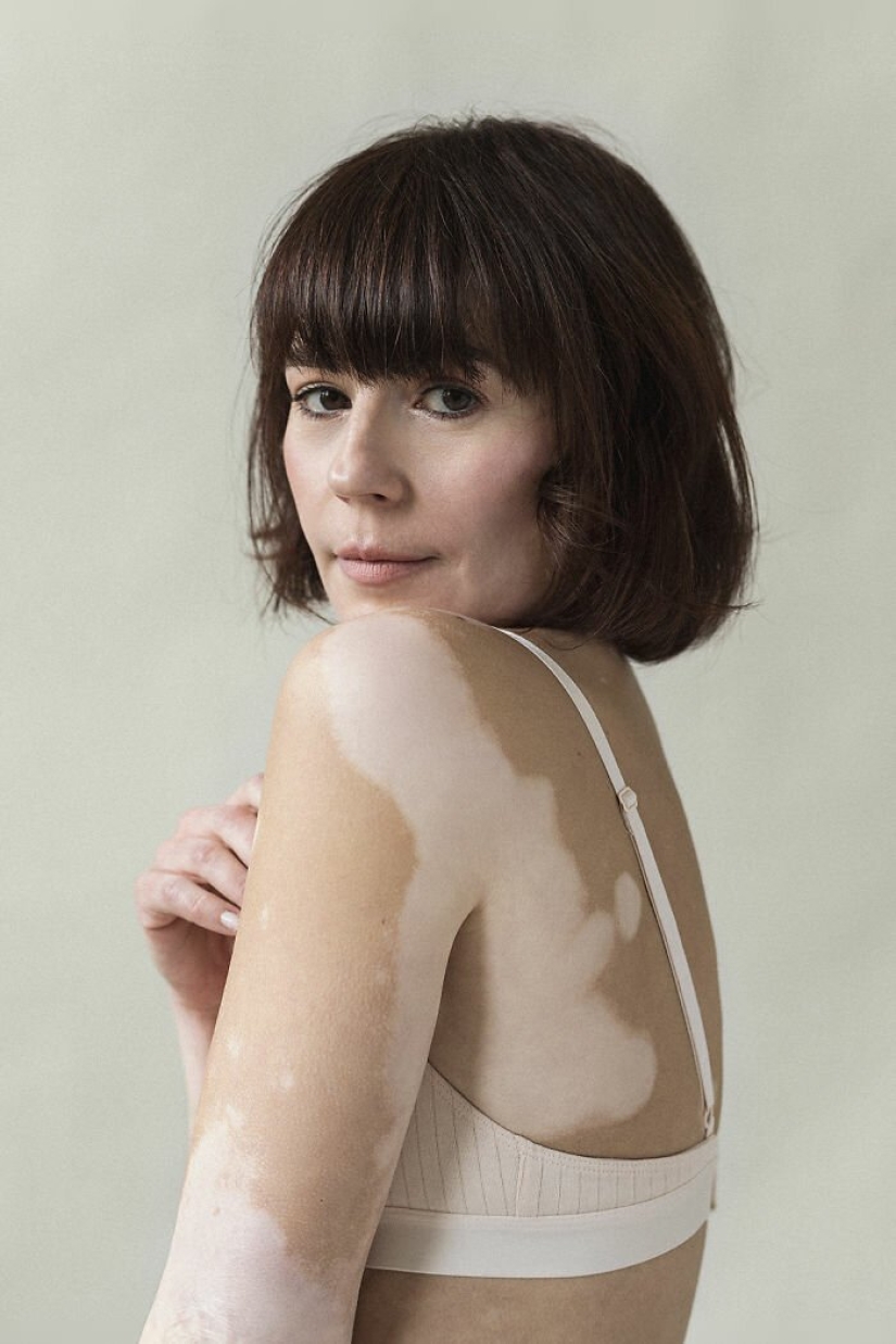 Models with vitiligo: beautiful and amazing