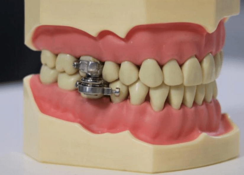 Mouth shut: scientists from New Zealand have come up with an ingenious way to lose weight