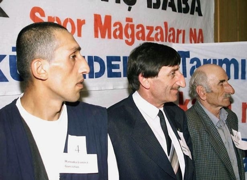 Pinocho en la vida real: el hombre con la nariz más larga del mundo