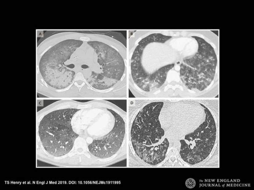 Shocking X-rays of light vapers Shocking X-rays of light vapers