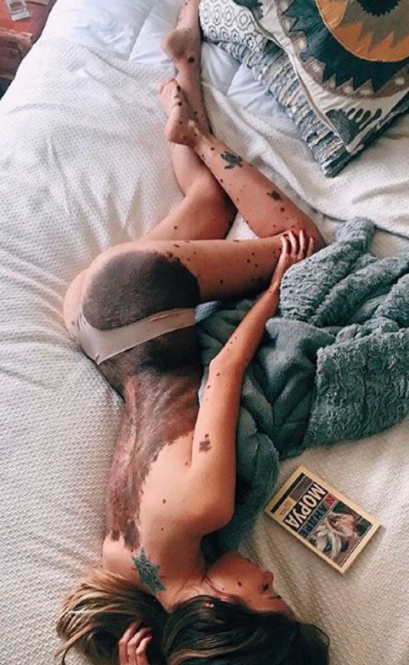 Signos especiales: debido a las marcas de nacimiento, la niña fue apodada "dálmata", pero se considera sexy