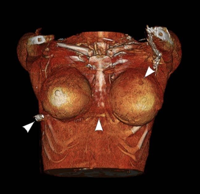 Silicone breast saved her mistress's life by stopping a bullet