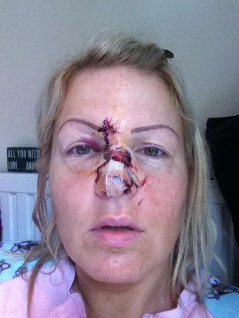 Solar ataúd: estas mujeres han adquirido un bonito bronceado y el cáncer de piel después de Solarium