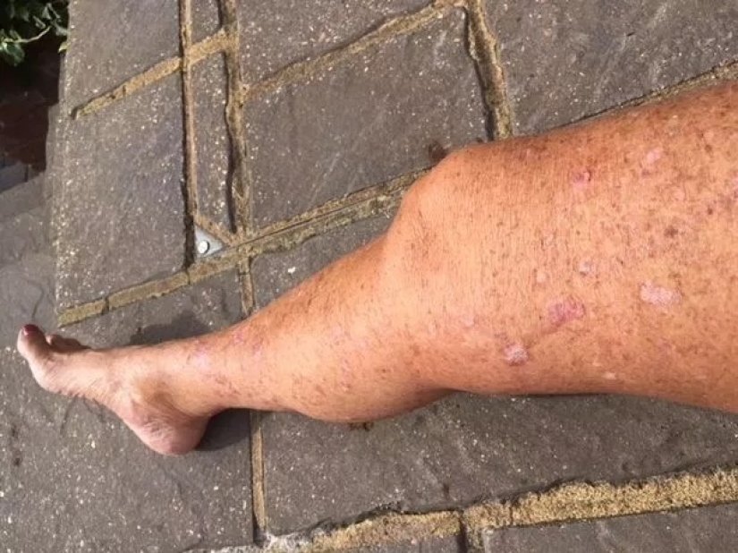 Solar ataúd: estas mujeres han adquirido un bonito bronceado y el cáncer de piel después de Solarium