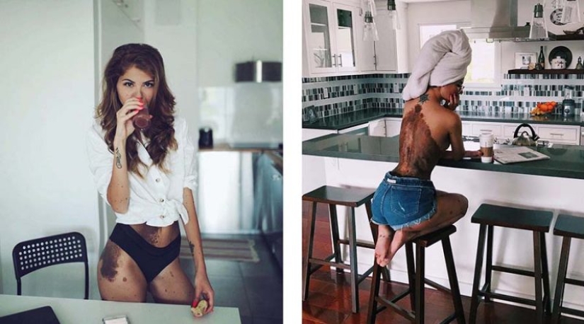 Special signs: because of birthmarks, the girl was nicknamed "Dalmatian", but she considers herself sexy