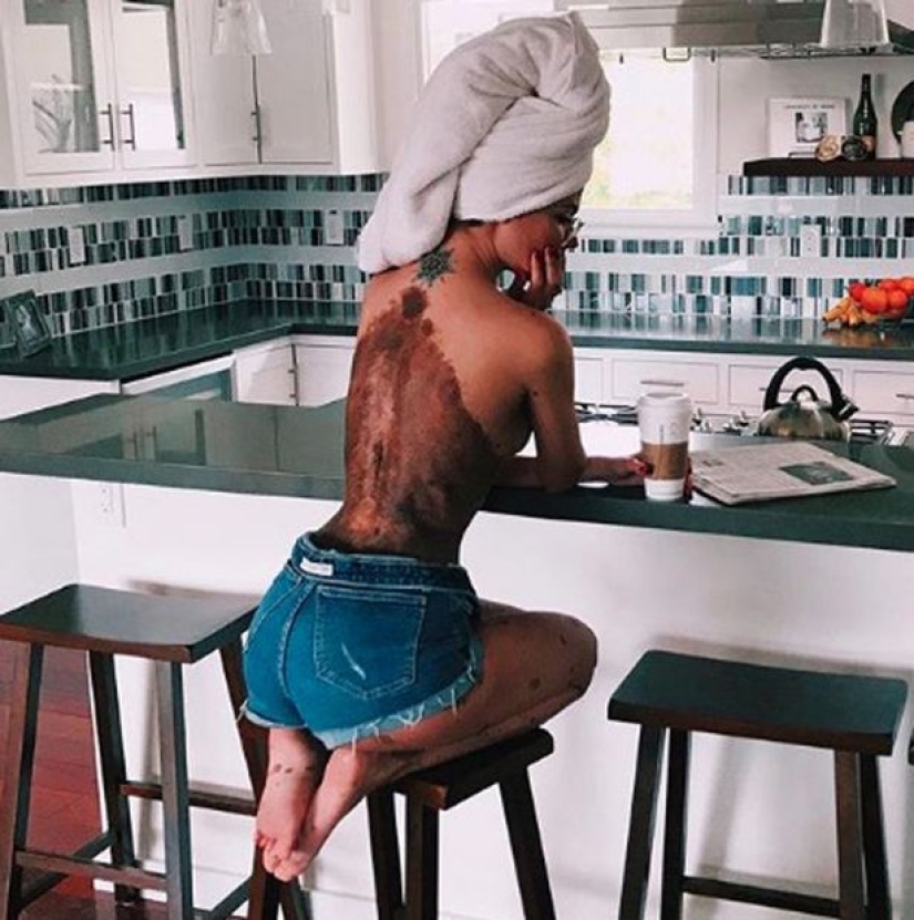 Special signs: because of birthmarks, the girl was nicknamed "Dalmatian", but she considers herself sexy