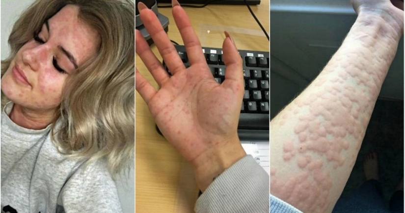 "Tengo miedo de abrir el refrigerador": cómo vive una niña con alergia al frío