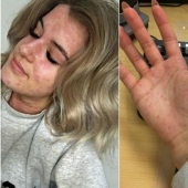 "Tengo miedo de abrir el refrigerador": cómo vive una niña con alergia al frío