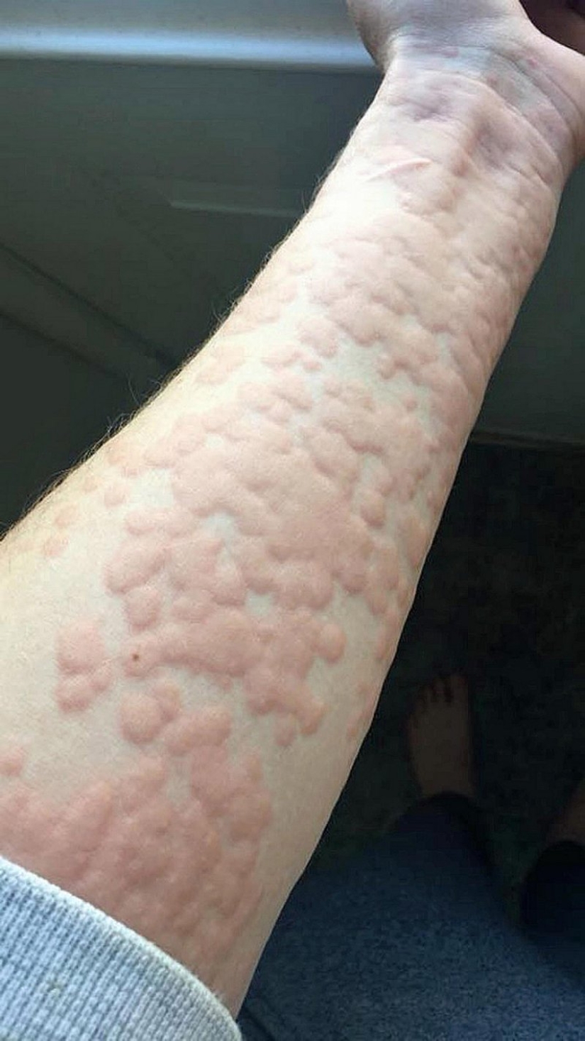 "Tengo miedo de abrir el refrigerador": cómo vive una niña con alergia al frío