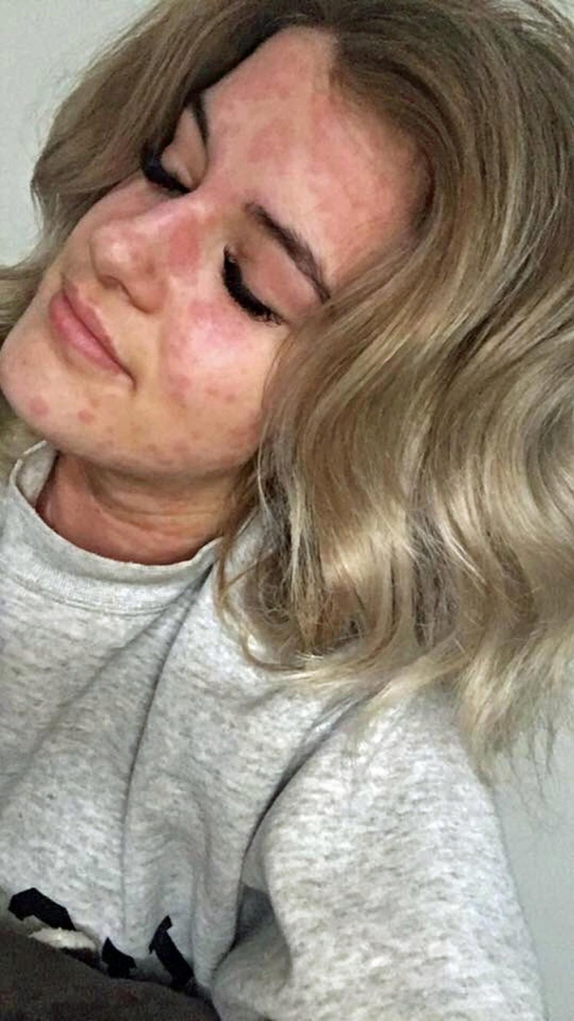 "Tengo miedo de abrir el refrigerador": cómo vive una niña con alergia al frío