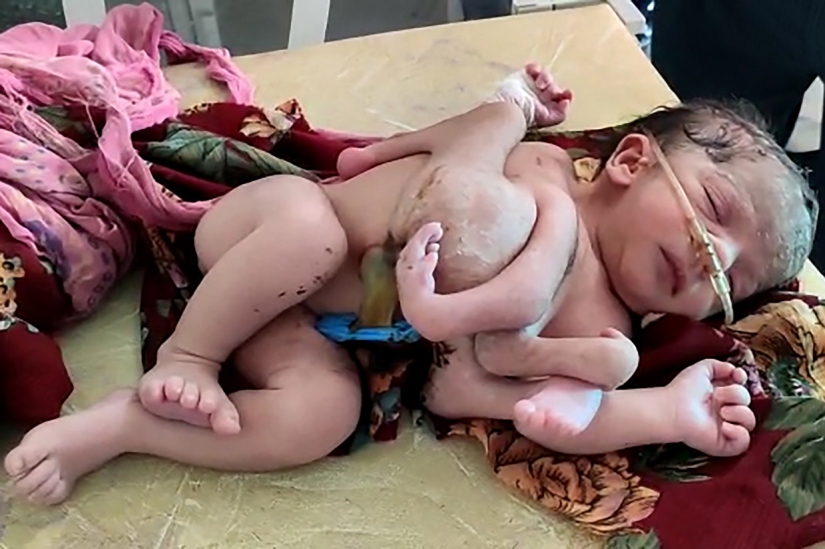 The curse of the god Shiva: a girl with four legs and three arms was born in India
