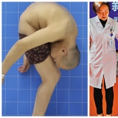 The man lived 28 years folded in half due to a rare disease