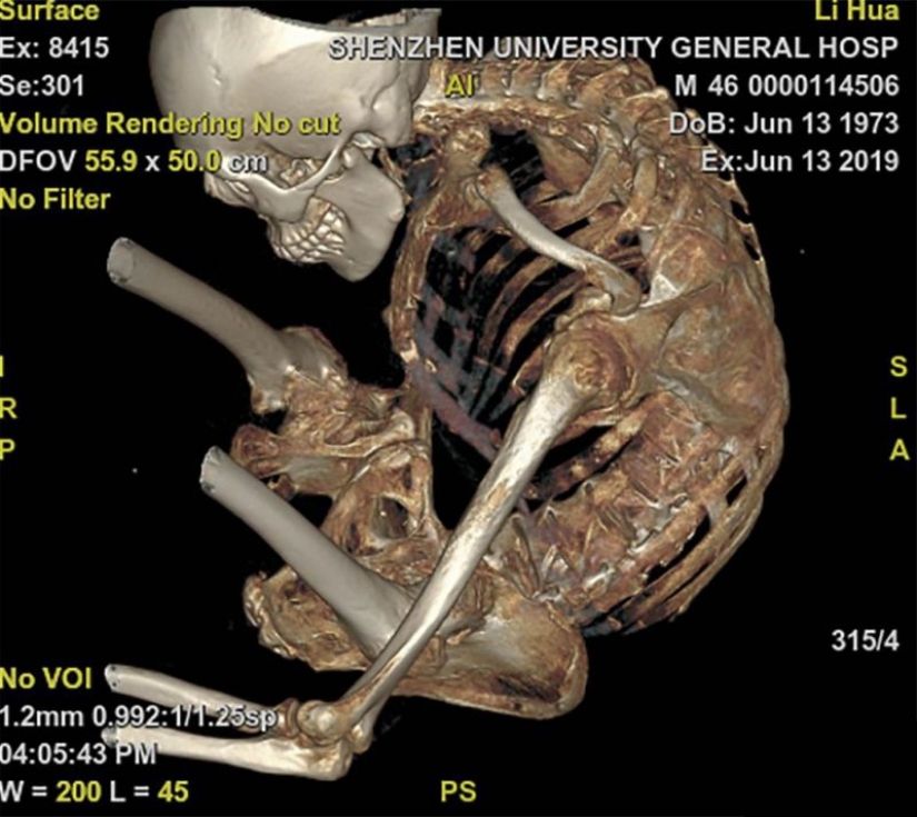 The man lived 28 years folded in half due to a rare disease
