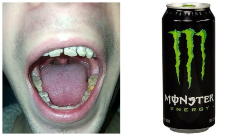 The power engineer who destroyed teeth and life: the 21-year-old guy lost his smile and dreams, regularly drinking an invigorating drink