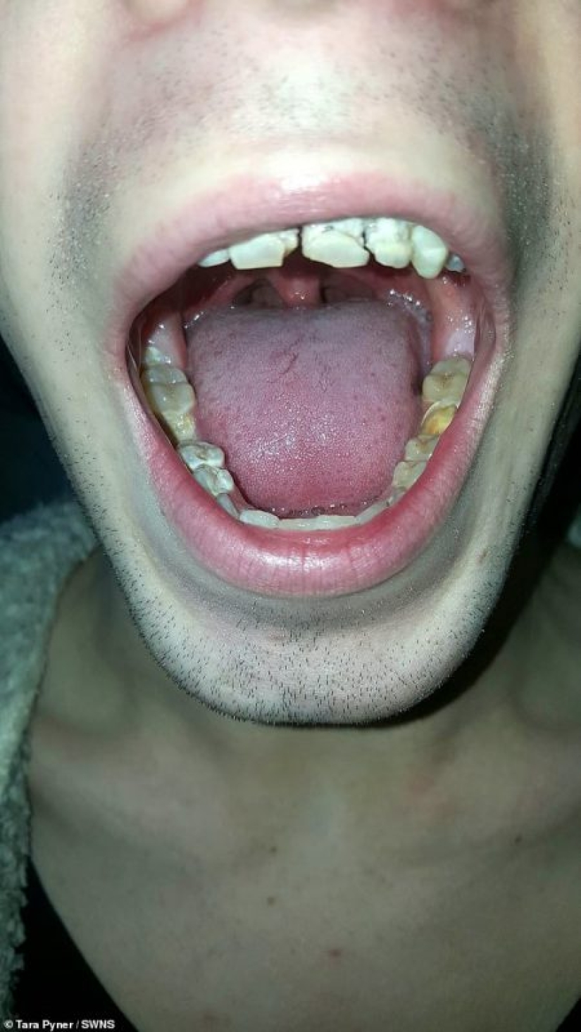 The power engineer who destroyed teeth and life: the 21-year-old guy lost his smile and dreams, regularly drinking an invigorating drink