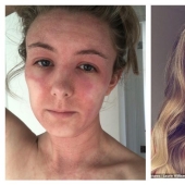 The result is evident: a woman got rid of the horrible eczema, throwing cream on steroids and becoming a vegetarian