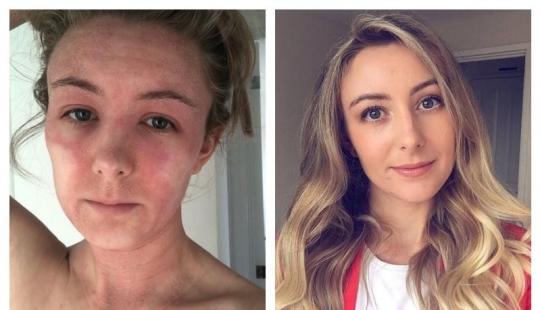The result is evident: a woman got rid of the horrible eczema, throwing cream on steroids and becoming a vegetarian