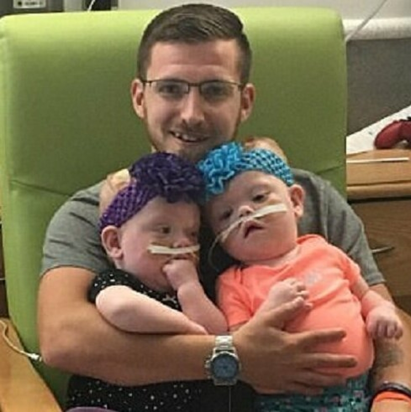 The right to life: 1.5-year-old Siamese twins, born with fused heads, recovered after a complicated operation and rejoice every day