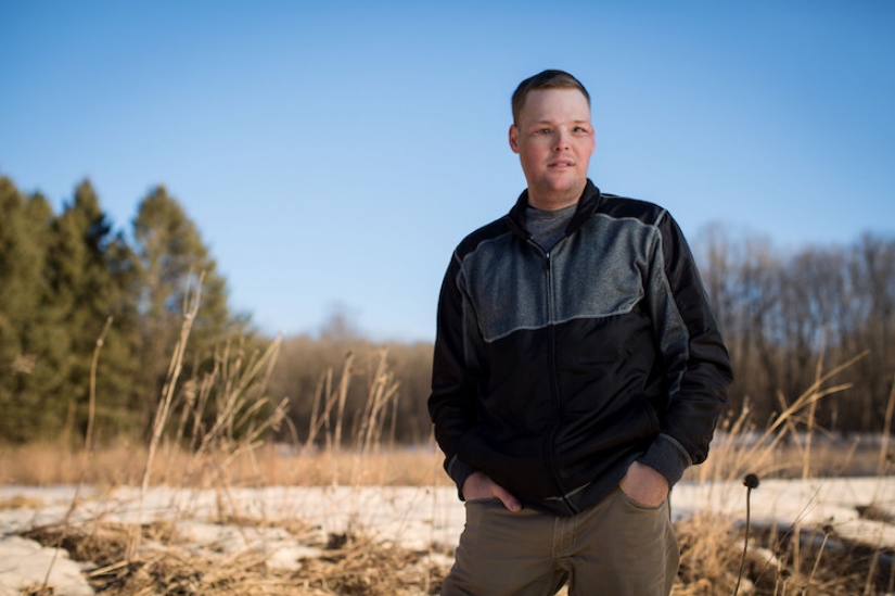 Un suicidio fallido le trasplantó la cara y comenzó una nueva vida para él