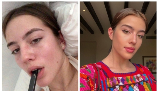 Una joven estadounidense casi queda discapacitada debido al vapeo Una joven estadounidense casi queda discapacitada debido al vapeo