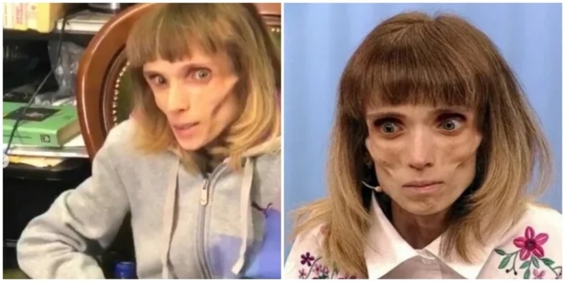 What does Kristina Koryagina look like now — a Russian woman who weighed 17 kg