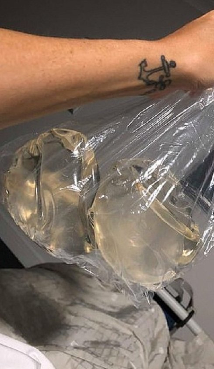 "With them, my life turned into hell": an Australian woman told why she got rid of breast implants