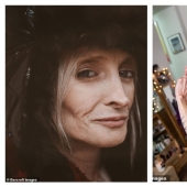 Young "old lady": a woman ages 8 times faster than usual due to "Benjamin Button" syndrome