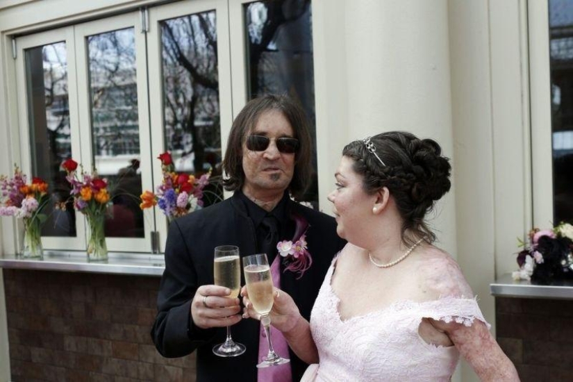 &#39;Man without a face&#39; marries after transplant