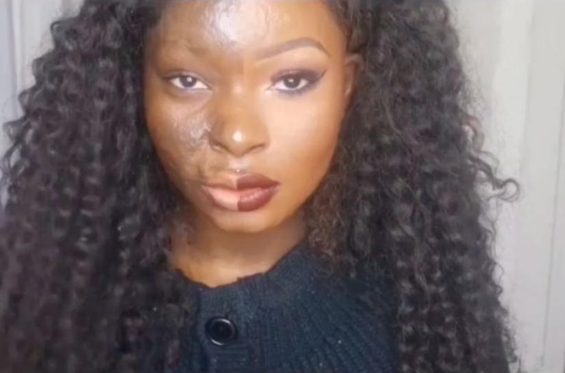 A girl with severe facial burns demonstrates the power of makeup A girl with severe facial burns demonstrates the power of makeup