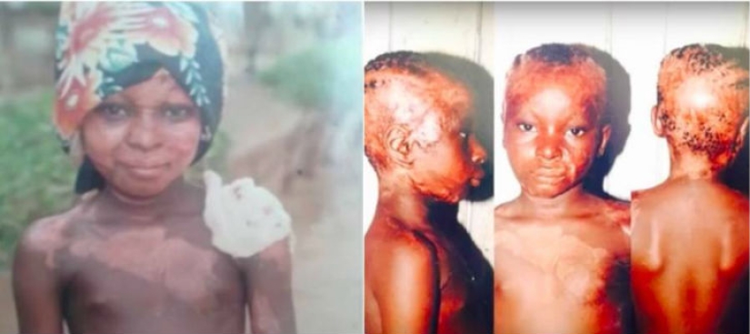 A girl with severe facial burns demonstrates the power of makeup A girl with severe facial burns demonstrates the power of makeup