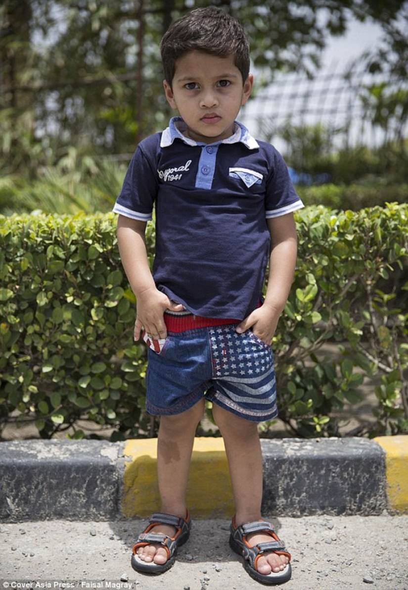 A two-year-old baby from India suffers from premature puberty A two-year-old baby from India suffers from premature puberty