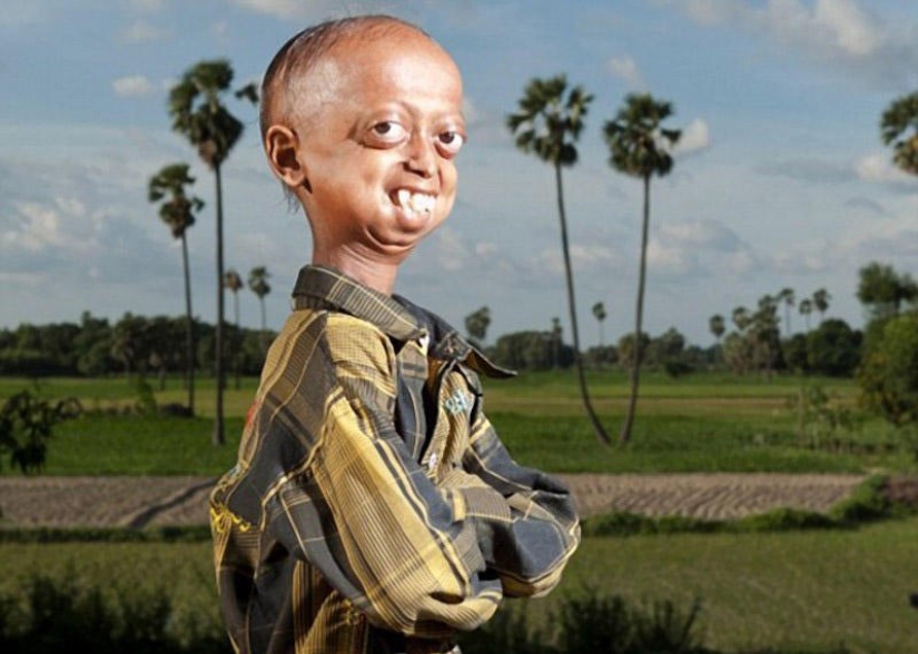 A very rare disease turned the boy into a pensioner A very rare disease turned the boy into a pensioner