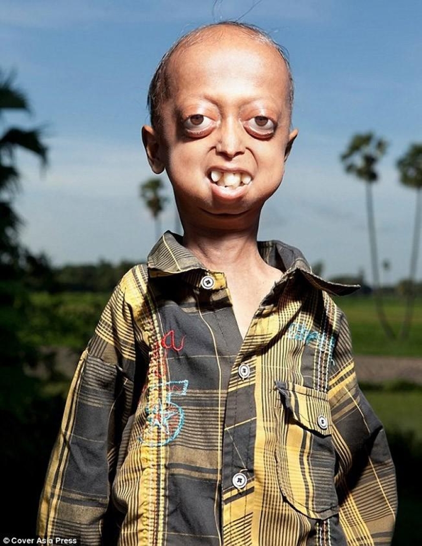 A very rare disease turned the boy into a pensioner A very rare disease turned the boy into a pensioner