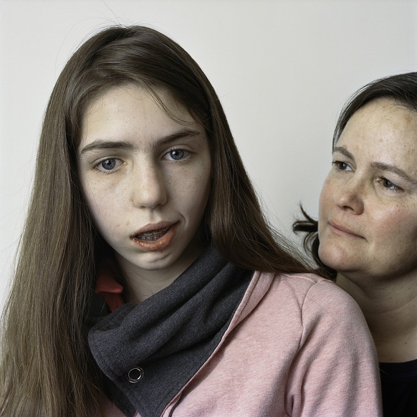 About Face: photo portraits of people suffering from paralysis About Face: photo portraits of people suffering from paralysis