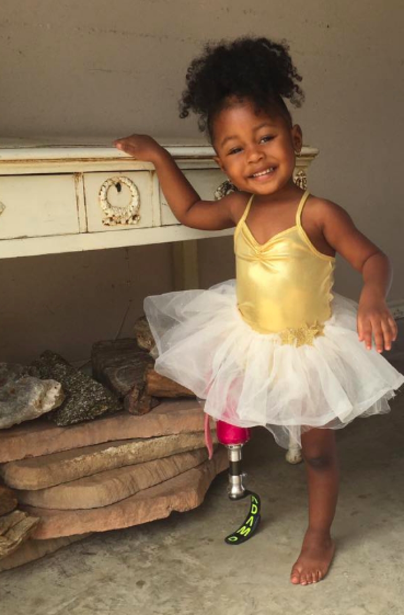 Aurora Cairo es una encantadora bebé de 2 años con una pierna protésica