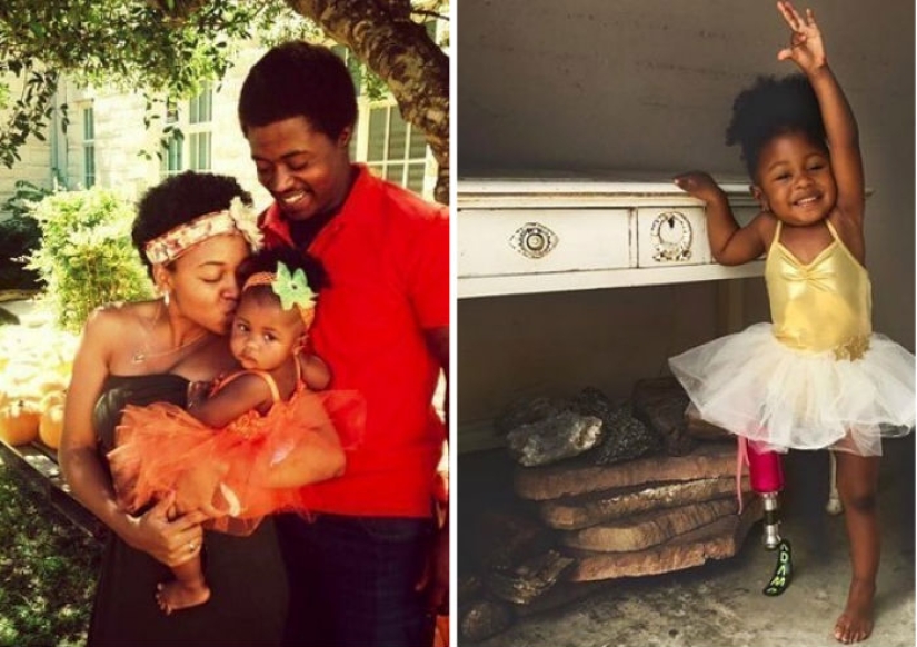 Aurora Cairo is a charming 2—year-old baby with a prosthetic leg