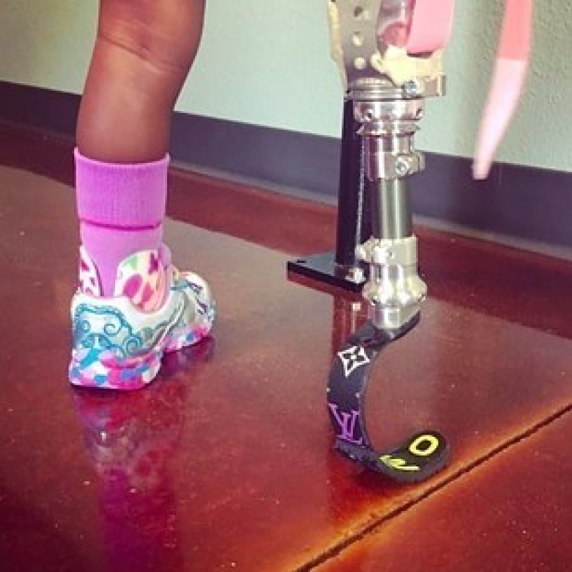 Aurora Cairo is a charming 2—year-old baby with a prosthetic leg