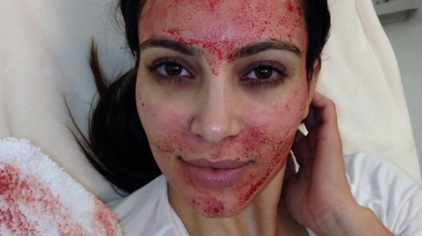 Beauty requires sacrifice: what are the stars doing in pursuit of eternal youth