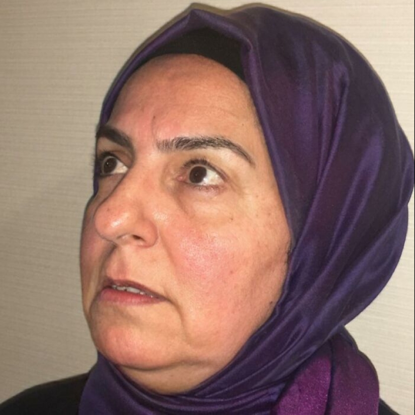 Before And After Photos From Turkish Plastic Surgery Clinic Have Left People Baffled